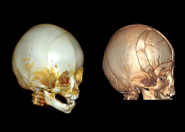Vinmec phẫu thuật tạo hình hộp sọ thành công cho bệnh nhi 10 tháng tuổi mắc dị tật hiếm gặp - Ảnh 2