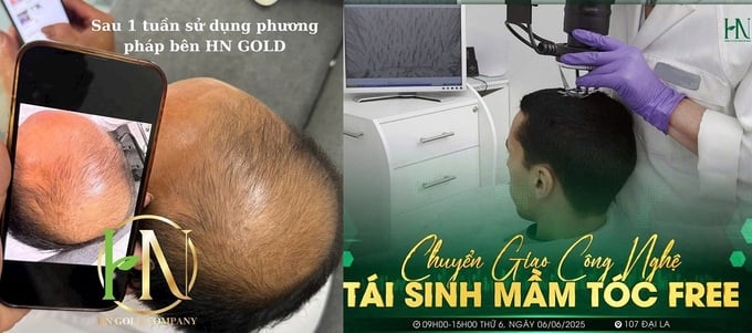 C&ocirc;ng nghệ t&aacute;i sinh mầm t&oacute;c thực chất chỉ l&agrave; sử dụng sản phẩm dầu gội xả th&ocirc;ng thường v&agrave; b&ocirc;i detox, serum kh&ocirc;ng nh&atilde;n m&aacute;c?