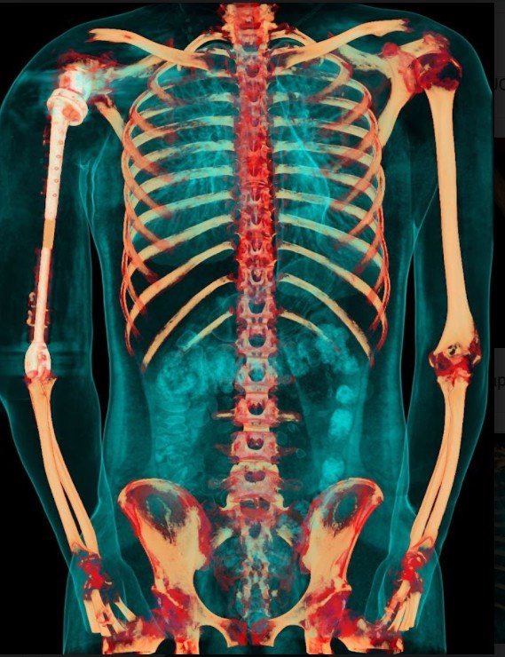 Ảnh chụp X-quang so s&aacute;nh xương c&aacute;nh tay 2 b&ecirc;n sau khi phẫu thuật &nbsp;